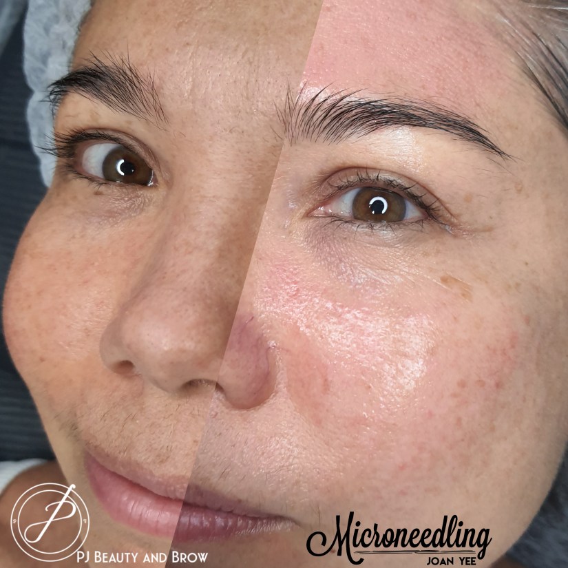 Natalie Microneedling Stem Cells